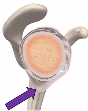 <ol><li><p>Superior Glenohumeral (GH) Ligament</p></li></ol><ul><li><p>Resists ER when the arm is ADD</p></li></ul><p></p><ol start="2"><li><p>Middle GH Ligament</p></li></ol><ul><li><p>Resists ER when arm is “neutral”</p></li></ul><p></p><ol start="3"><li><p>Inferior GH Ligament</p></li></ol><ul><li><p>Anterior band: Resists ER when arm is ABD</p></li><li><p>Posterior band: Resists IR when arm is ABD</p></li><li><p>Axillary fold is between ant and post fibers (purple arrow)</p></li></ul><p></p>
