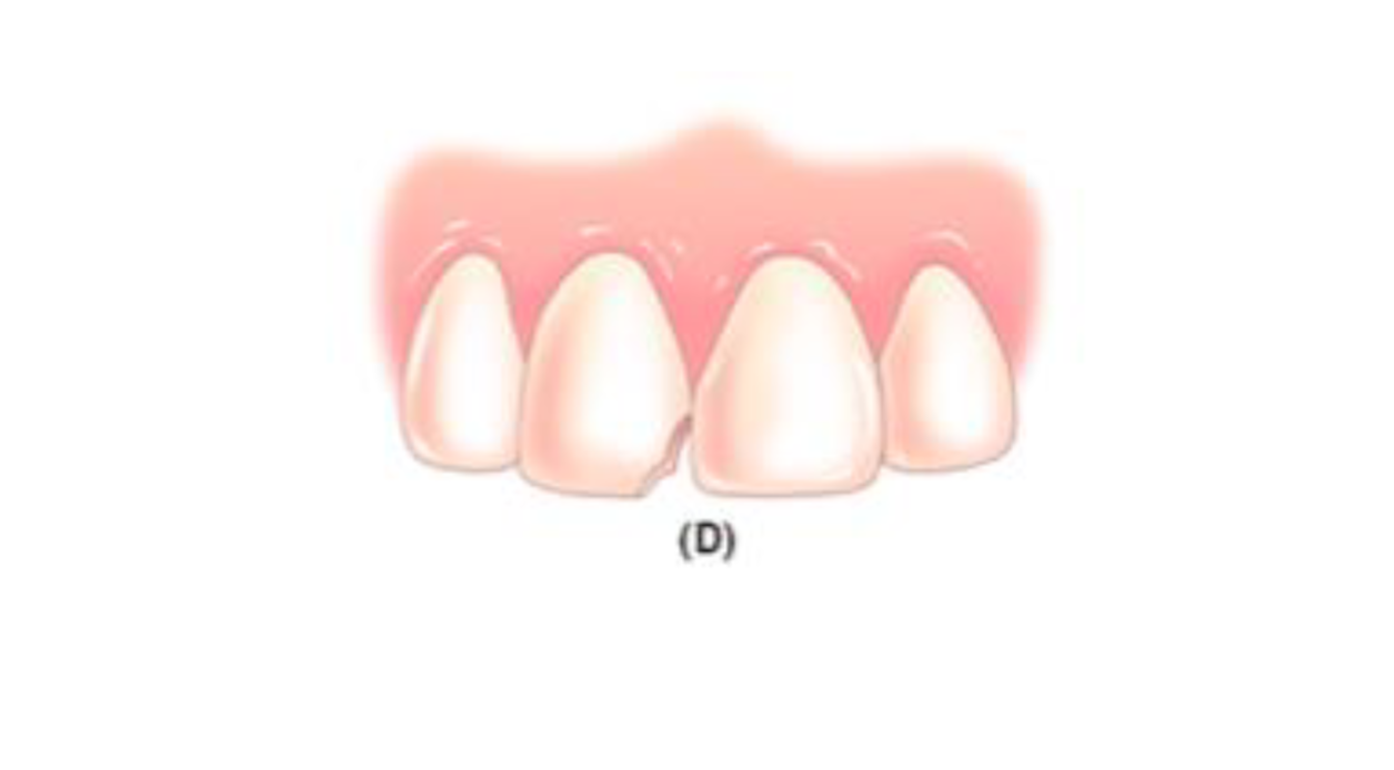 <p>Interproximal (mesial or distal) surface of anterior teeth involving the incisal edge.</p>