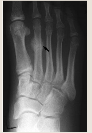 <p>what type of fracture is this</p>