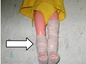 <p><span>ankles, tarsals and metatarsals affections with open wound, swelling and infection</span></p>