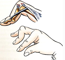 <ul><li><p>Patients present with pain on dorsal side of PIP and the inability to extend at joint </p></li><li><p>The deformity is often absent at initial presentation as the band slowly migrate volarly </p></li><li><p>This results in PIP joint flexion and hyperextension at the distal interphalangeal (DIP) joint</p></li></ul><p></p>