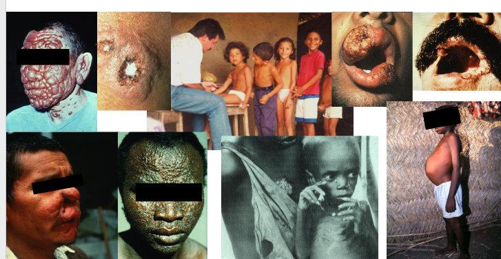 <p>Leishmaniasis - One disease, many phenotypes</p>