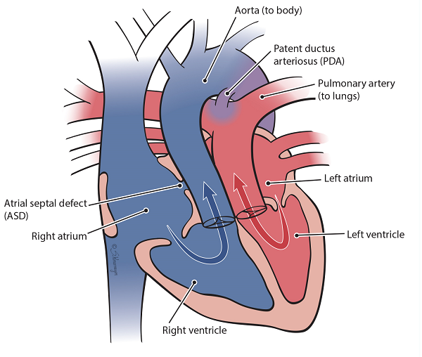 <p>transposition of great arteries</p>