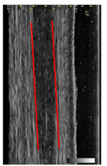 <p>Score 0 - ≥ 75% parallel fibres within target image/path</p><p> • Score 1 - 50-75% parallel fibres within target image/path • </p><p>Score 2 - 25-50% parallel fibres within target image/path • </p><p>Score 3 - 25% parallel fibres within target image/path</p>