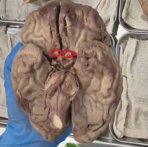 <p>red: optic nerves</p><p>where the crossing occurs: optic chiasm</p>