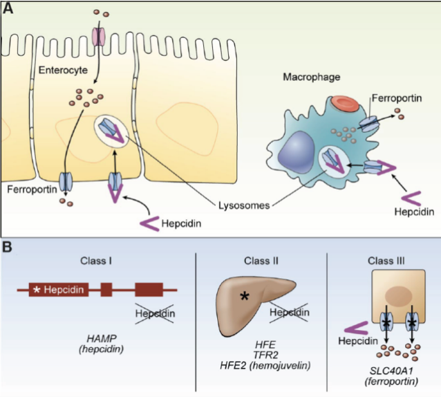 <p>Hepcidin blocks export through ferroportin, but it also causes these channels to be endocytosed and digested.</p><p>Genetic diseases that lead to <em>excessive systemic iron</em> include:</p><ul><li><p>Non-functional genes for hepcidin itself (class I)</p></li><li><p>Non-functional genes for proteins that regulate hepcidin gene regulation(class II)</p></li><li><p>Ferroportin alleles that code for a protein (ferroportin) that fails to be bound and stopped by hepcidin (class III).</p></li></ul><p></p><p>Excess iron symptoms are called <em>hemochromatosis</em>.</p><ul><li><p>If you have excess iron and lack hepcidin, you can use leeches to relieve your symptoms!</p></li></ul><p></p>