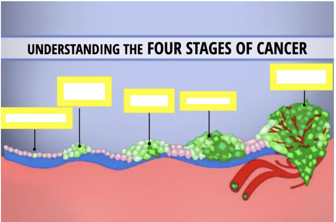 <p>The Multistage Development of Neoplasia </p>