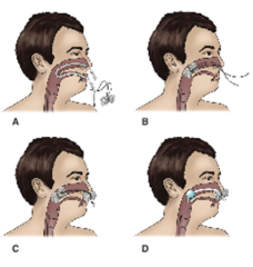 <p>what are some medical managements for epistaxis</p>