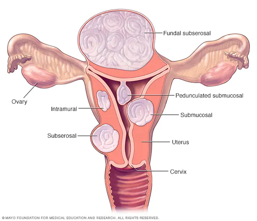 <ul><li><p>Fibroids: tumors of uterine wall</p><ul><li><p>Worry about submucosal: won’t be able to compress vessels well post-partum, which can lead to post-partum hemorrhage </p></li></ul></li><li><p>Causes:</p><ul><li><p>Heavy vaginal bleeding</p></li><li><p>Prolonged bleeding</p></li><li><p>Often asymptomatic</p></li></ul></li><li><p>Treatment</p><ul><li><p>Depends on severity</p></li><li><p>Hormonal methods</p></li><li><p>Myomectomy (removal of fibroids)</p></li><li><p>Uterine fibroid embolization</p></li><li><p>Hysterectomy</p></li></ul></li></ul><p></p>