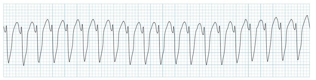 <p>What pathology is shown on the ECG? What are the defining characteristics?</p>
