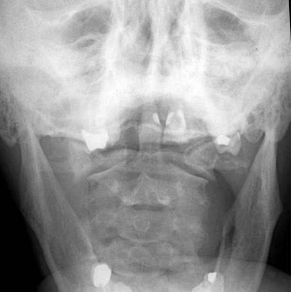 <p>What is the finding and what is the diagnosis?</p>