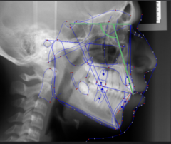 <p>What dental measurement:</p><p>- Sella-Nasion vs Long Axis of U1</p><p>- AP relationship between the cranial base and the upper incisors</p><p>- Tells you about the angulation of the upper incisors</p>