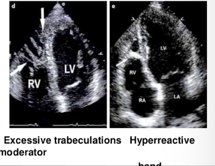 <p>What pathology does this ECHO look like?</p>