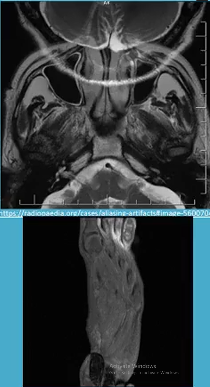 <p>Aliasing refers to when the filed of view (FOV) is smaller than the body part being imaged </p><p></p><p>Resolved by:</p><ul><li><p>enlarging FOV</p></li><li><p>Anti-aliasing software</p></li><li><p>switch phase and frequency directions</p></li></ul><p></p>