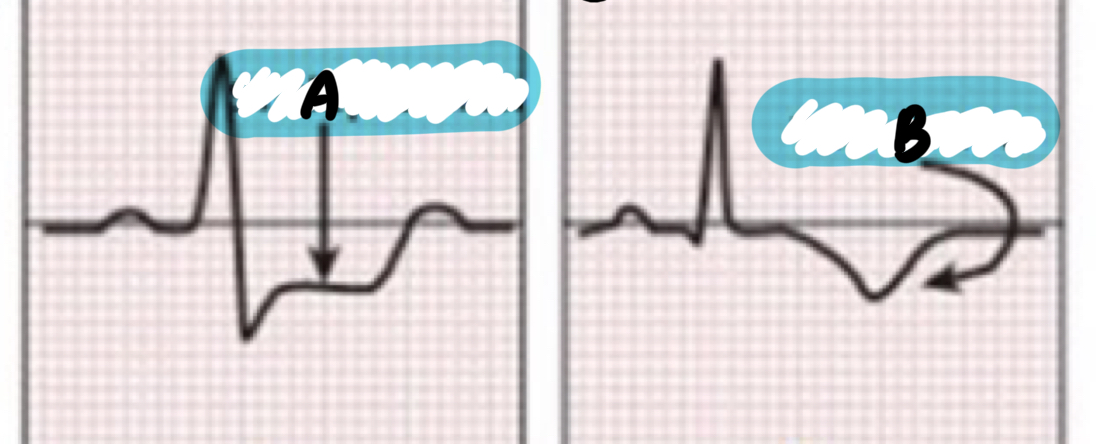 <p>List these features of an ECG that occur for patients with unstable angina during an episode</p>