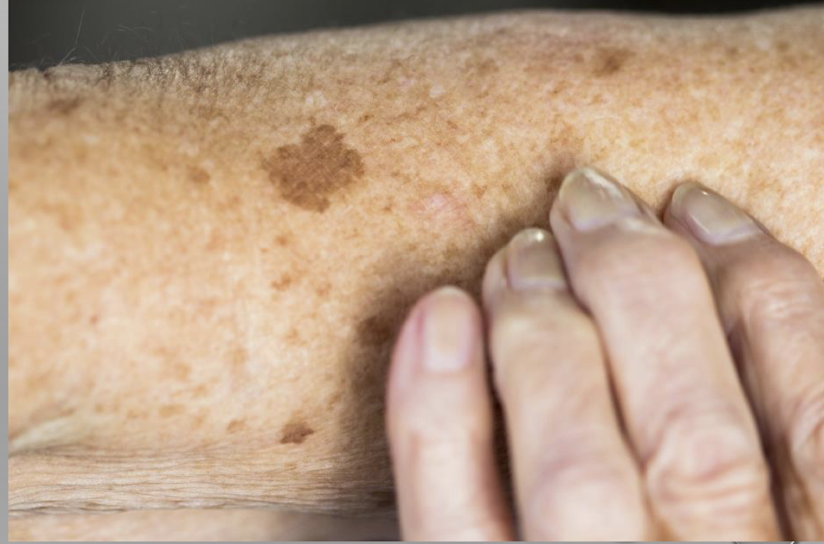 <p>benign: increased number of normal melanocytes in the basal layer of the epidermis; aka liver spots or age spots </p><p>cause: sun exposure and aging</p><p>symptoms: hyper pigmented, brown to black macule or patch on the sun-exposed skin </p><p>treatment: evaluated regularly for changes (biopsy if needed), may want removed for cosmetic purposes </p>