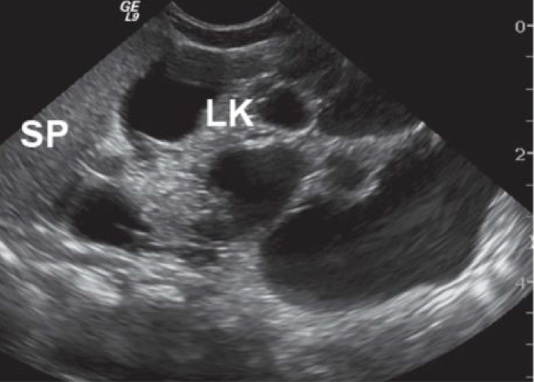 <p>contralateral UPJ obstruction, nonfunctioning kidney, UNILATERAL</p><ul><li><p>neonates/children </p><ul><li><p>multicystic (bunch of grapes)</p></li><li><p>absence of renal parenchyma, renal sinus, atretic renal artery </p></li></ul></li><li><p>adults </p><ul><li><p>small atrophic/calcified kidney, echogenic </p></li></ul></li></ul><p></p>