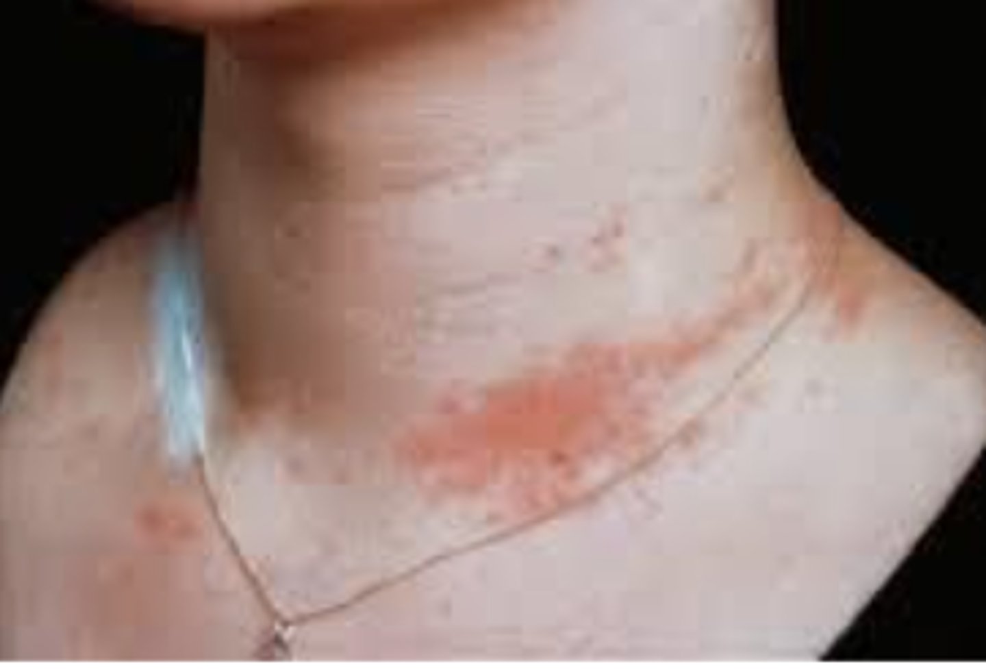 <p>Abbreviated ACD; an allergy to an ingredient or a chemical, usually caused by repeated skin contact with the chemical.</p>