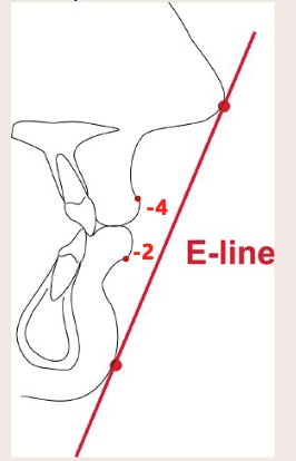 <p>Nasal tip to soft tissue chin</p>