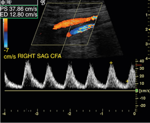 <p>atherosclerosis</p>