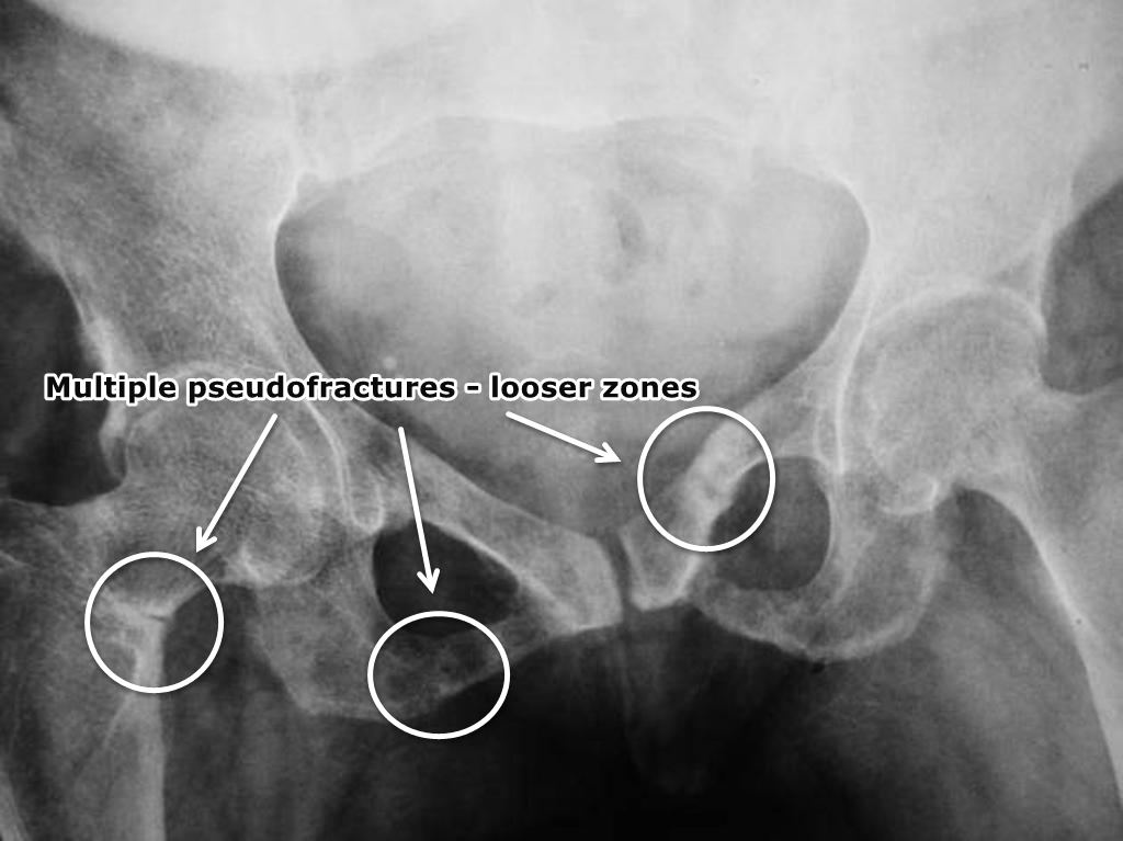 <p>‘Soft bone’ - caused by vitamin D, calcium or phosphate deficiency</p><p><u>Radiographic appearance</u></p><ul><li><p>incomplete fractures</p></li><li><p>smudgy/erased looking trabeculae due to decreased bone density</p></li><li><p>Looser zones (pseudofractures) appearing as lucent bands in the femoral neck</p></li></ul><p></p>