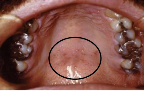 <p>what are these lesions associated with</p>