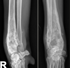 <p>multiple small, irregular, poorly defined areas of bone loss</p>