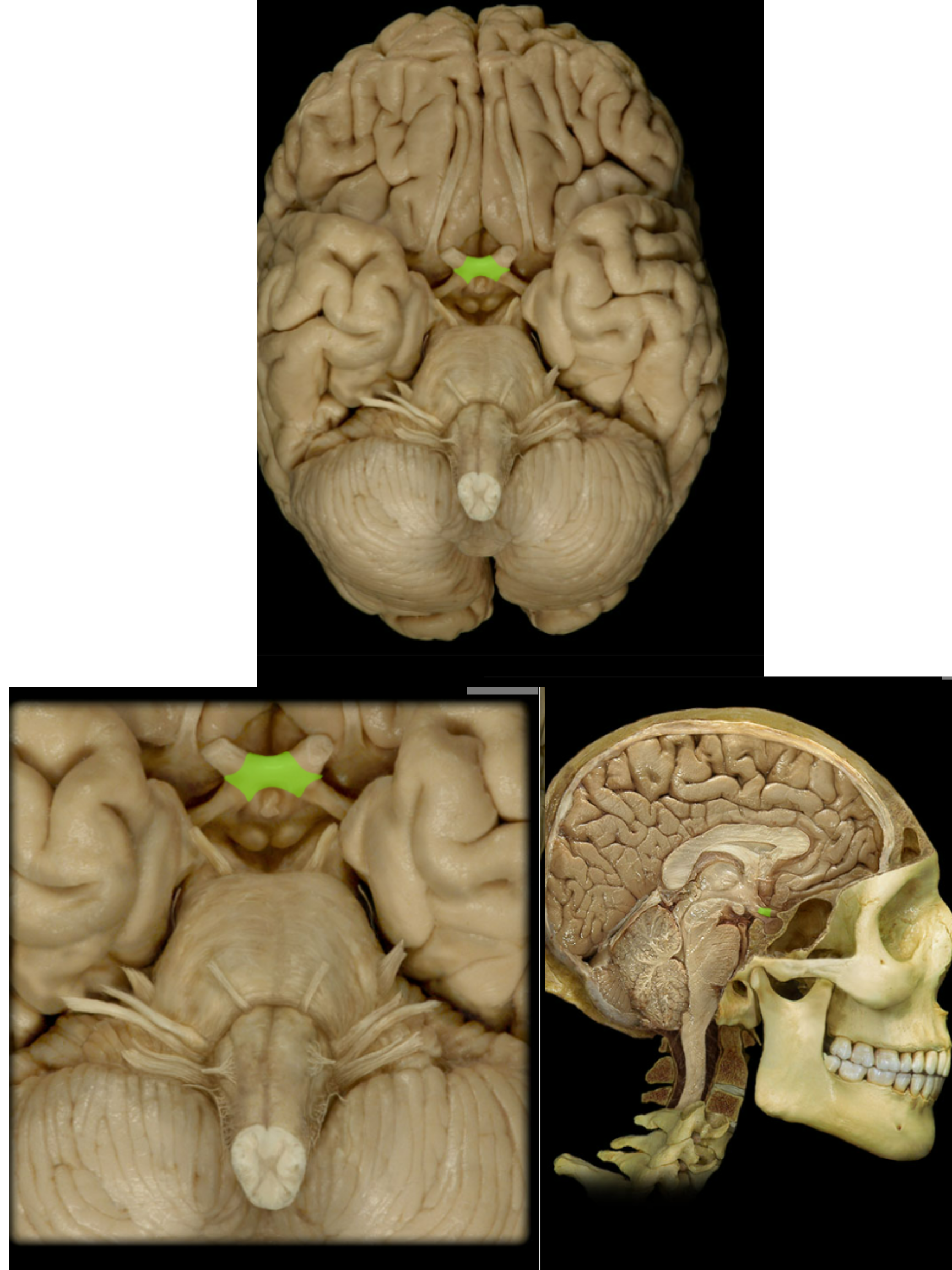 <p><span>Optic chiasm</span></p>