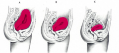 <p>- Rapid reduction in size of uterus post birth to its pre-pregnant state</p><p>- Immediately after delivery large grapefruit mass midway between symphysis & umbilicus</p><p>- Within a few hours should be firm, well-contracted, midline and @ level umbilicus</p><p>- Fundal height decreases 1cm or 1 finger breadth per day</p><p>- Breastfeeding aids involution</p><p>- Placental site heals by exfoliation</p>