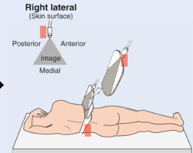 <p>Patient lays on left side</p><p>Enables scanning of right lateral surface  </p>