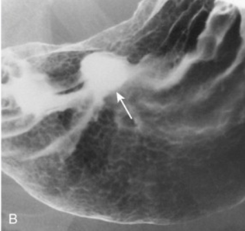 <p>This is a double contrast examination. What is it showing? </p>