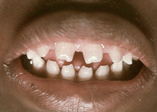 <p>intra-oral presentation of congenital syphilis; “screwdriver” incisor </p>