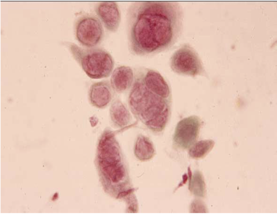 <p>what are these cells called and which disease can you see these cells</p>