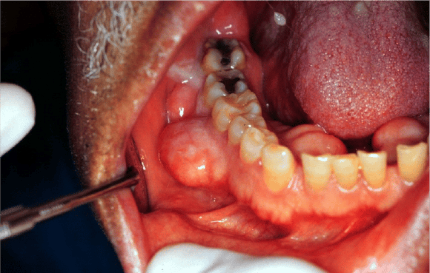 <p>Bony growth (benign) arising from the surface of bone</p>