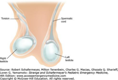<p>Testicle presents as high-riding with horizontal lie, with epididymis located anteriorly instead of posteriorly.</p>