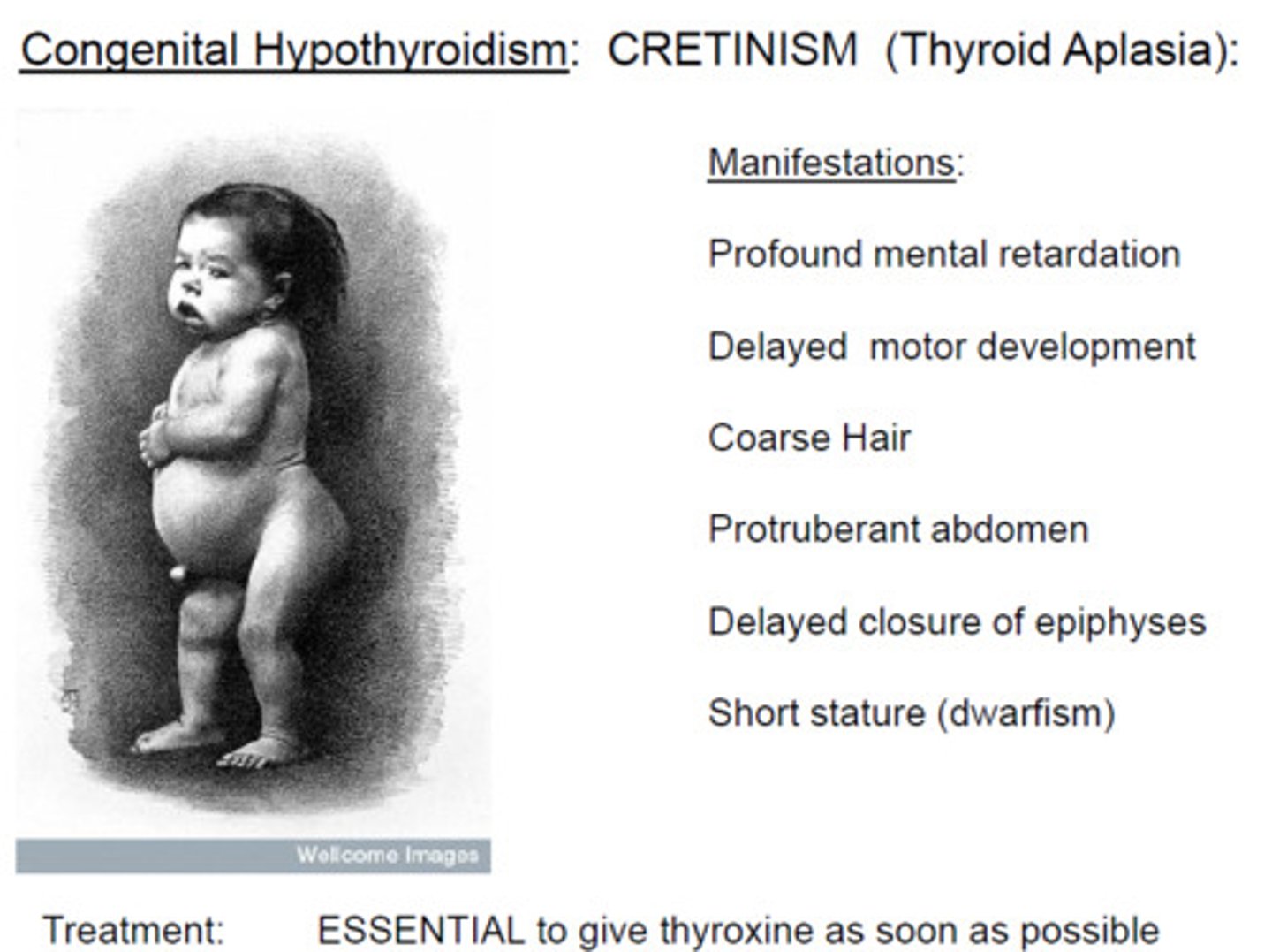 <p>The condition that results from hypothyroidism in children</p>