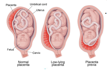 <p><strong>• Definition:</strong> placenta implanted in lower uterine segment near or over internal cervical os</p><p><strong>• Degree to which the internal cervical os is covered by placenta</strong> <strong>used to classify three types</strong></p><p>• Complete placenta previa</p><p>• Marginal placenta previa</p><p>• Low-lying placenta</p><p>• Incidence and etiology</p><p>• 1 in 200 pregnancies</p><p><strong>• Risk Factors include:</strong> Previous c-birth, advanced maternal age (more than 35 to 40 years of age), multiparity, history of prior suction curettage, living at a higher altitude and smoking</p>