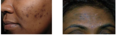 <p>in skin of color, can lead to permanent post-inflammatory hyperpigmentation </p><p>>treat aggressively to prevent this complication</p>