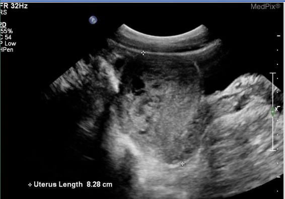 <p>A complication of pregnancy that most commonly follows gestational</p><p>trophoblastic disease by can also (uncommonly) occur after normal</p><p>term delivery, spontaneous abortion, or even ectopic pregnancy</p>