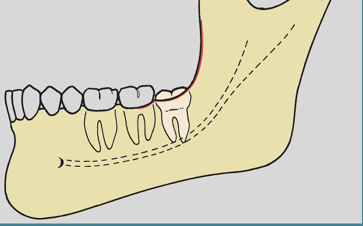 <p>the mesiodistal diameter of the crown is completely anterior to the anterior border of the ramus</p>