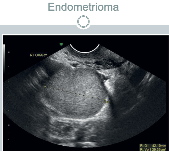 <ul><li><p>may be diffuse or local</p></li><li><p>ectopic placement of the endometrium outside the uterine cavity</p></li><li><p>most common site is the ovary</p><ul><li><p>but can spread throughout the pelvic + sometimes throughout the body</p></li></ul></li><li><p>focal form is endometrioma</p></li></ul><p></p>