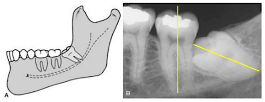 <p>mesioangular</p>