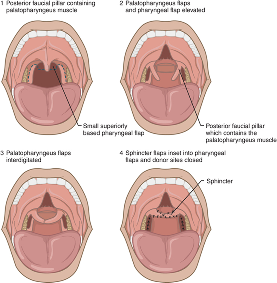 <p>What VPI surgery is this?</p>