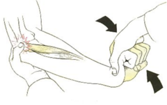 <p>Resisted wrist extension/radial deviation with pronated forearm; identifies lateral epicondylopathy.</p>