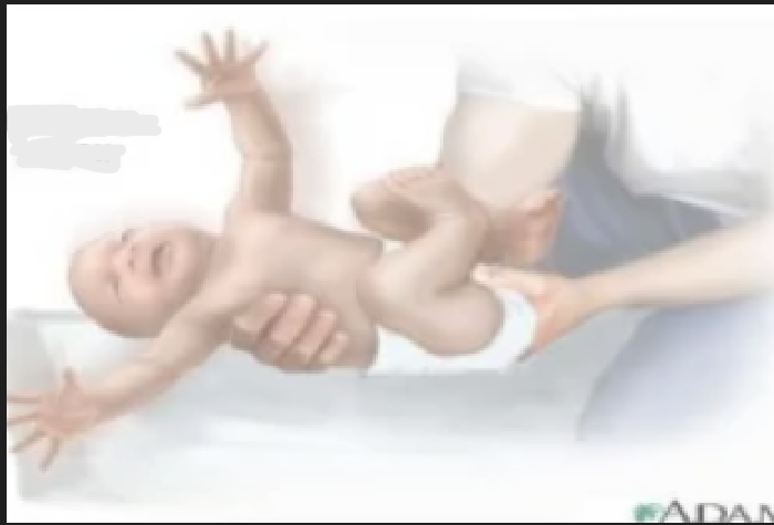 <ul><li><p>primitive - brainstem</p></li><li><p>baby in supine position; support baby’s head. allow head to drop back 20 to 30 degrees (in relation to trunk) => abduction and extension of upper extremity followed by flexion and adduction</p></li><li><p>look for symmetry of response</p></li></ul><p></p>