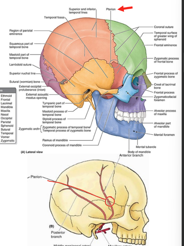 <ul><li><p>part of lateral aspect of cranium</p></li><li><p>ant. part of temporal fossa</p></li><li><p>3-4 cm<strong> sup. to midpoint of zygomatic arch</strong></p></li><li><p>usually indicated by H-shaped formation of sutures that unite frontal, parietal, sphenoid, & temporal bones</p></li><li><p><strong>pterion fracture</strong></p><ul><li><p>can be life-threatening</p></li><li><p>rupture of branches of<strong> middle meningeal artery</strong> & epidural hematoma</p></li></ul></li></ul><p></p>