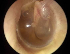 <p>Serous Otitis Media</p>