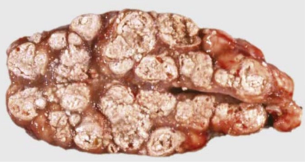 <p>What type of necrosis is this?</p>
