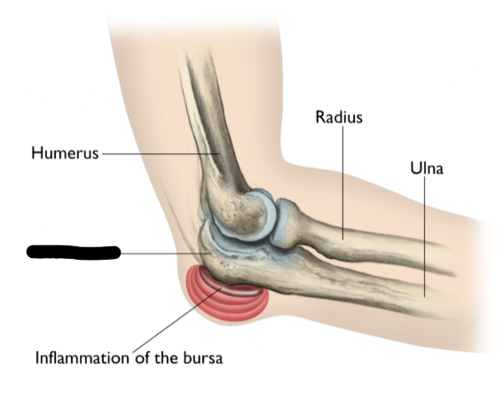 <p>What Elbow Ligament?</p>