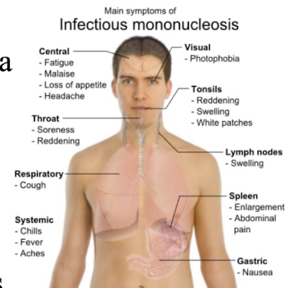 <p><strong>Primary infection in adolescents </strong>– saliva i.e. kissing a virus shedding carrier</p><p><mark data-color="red" style="background-color: red; color: inherit;">Sx: Sore throat, fever, headache, fatigue, rash uncommon</mark></p><ul><li><p><strong>Generalised lymphadenopathy</strong> is <strong><u>almost always present</u></strong>; marked in cervical region (neck)</p></li><li><p><strong>Splenomegaly in about 60% cases; enlarged liver in 10%</strong></p></li><li><p>Mild cases resolve in days but 1-4 weeks more common; convalescence</p></li></ul><p></p>